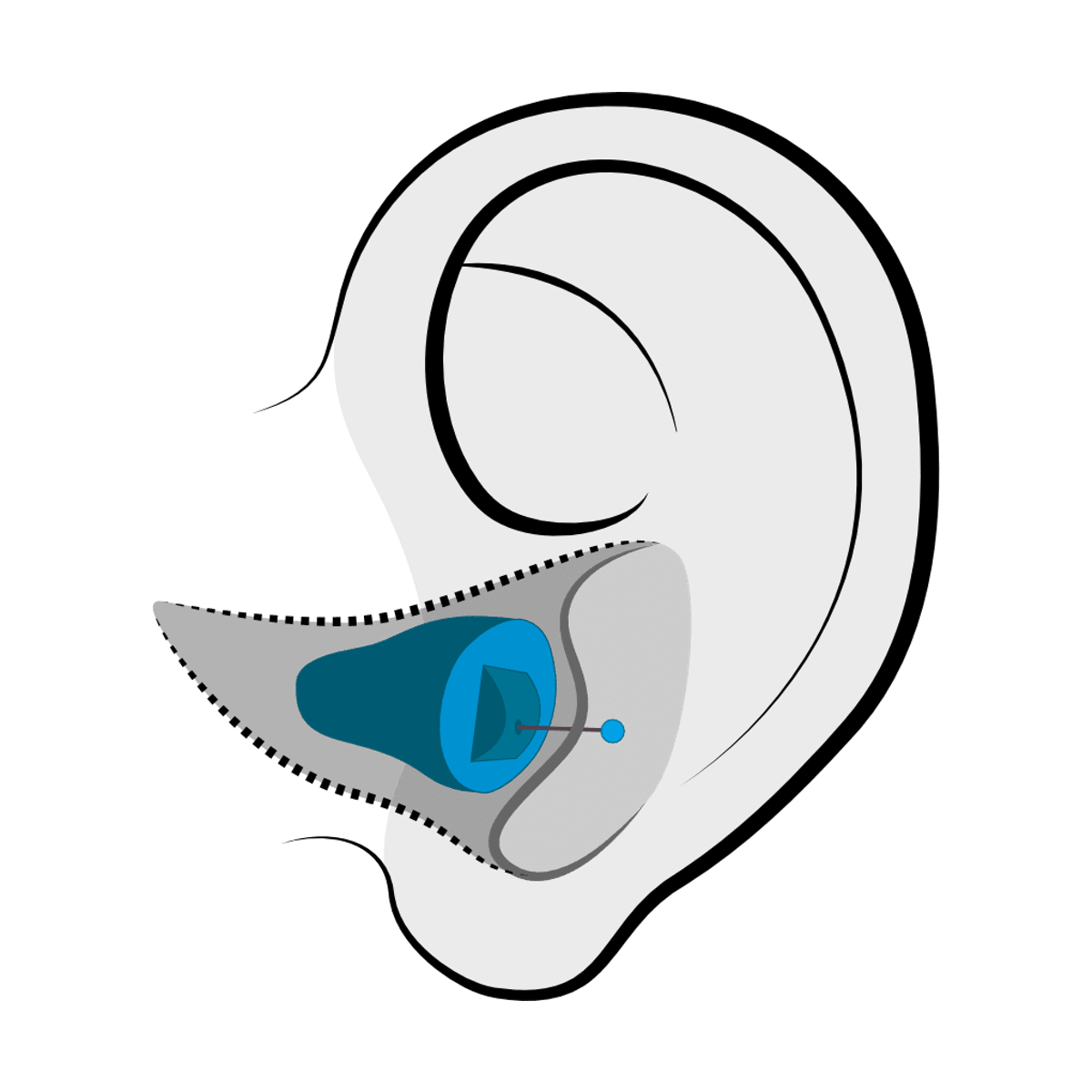 Invisible-in-Canal (IIC) hearing aid style fitted at Brighter Hearing in Savannah, GA